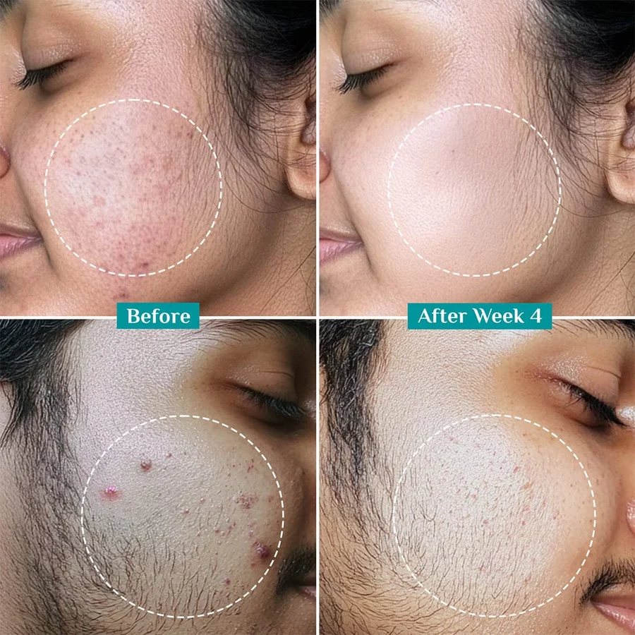 2% Salicylic Acid Anti-Acne Face Serum